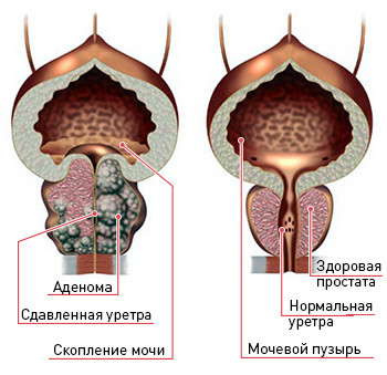 Хронический простатит конгестивная форма